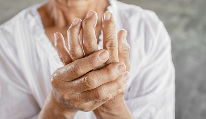 12.7EarlyWarningSignsofRheumatoidArthritis Hands of Old Man Showing Rheumatoid Arthritis