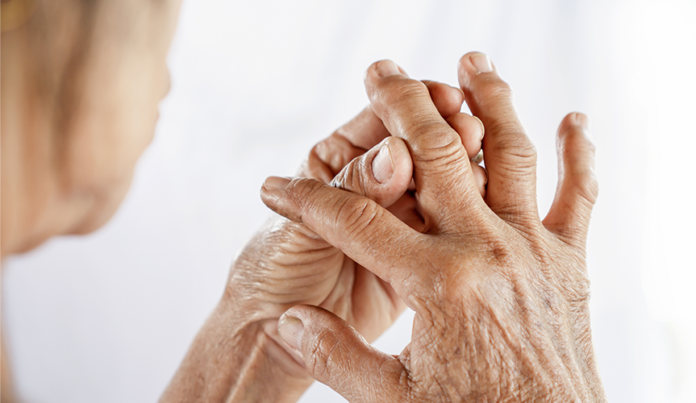 Psoriatic arthritis