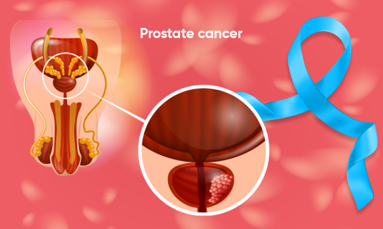 prostate cancer