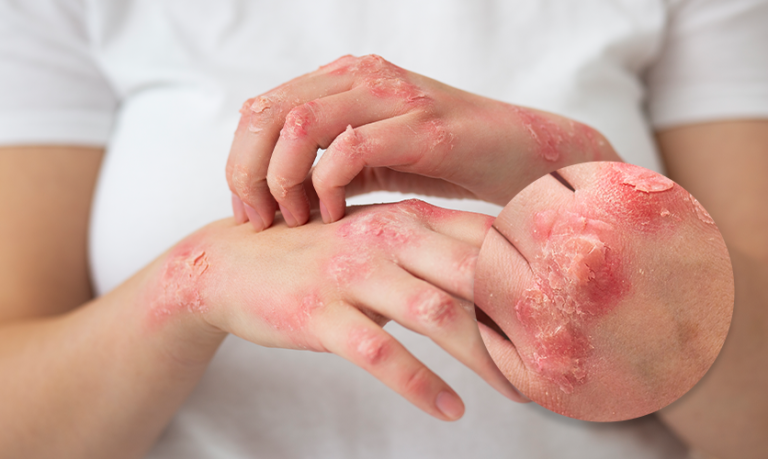 Can Psoriasis be Cured